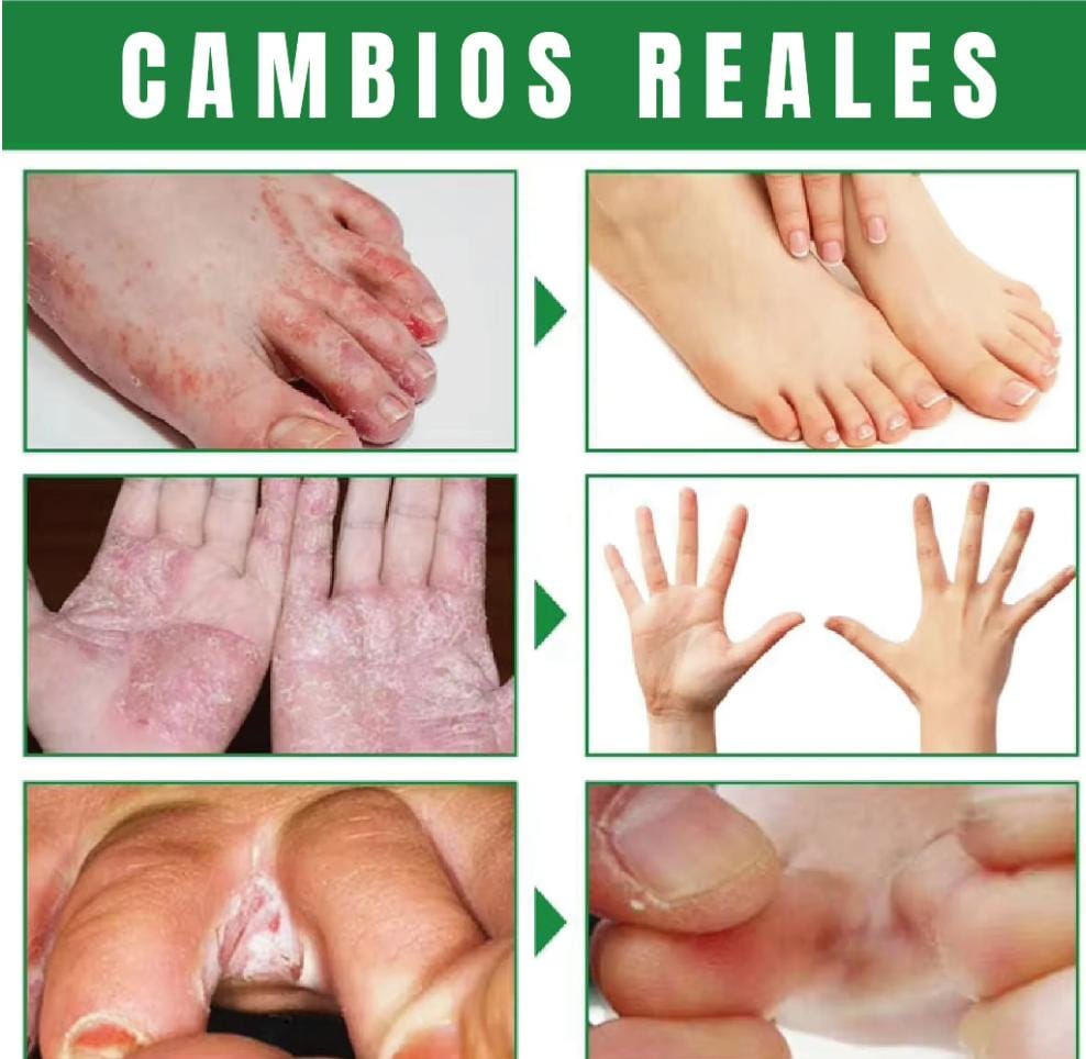 Spray AntiHongos