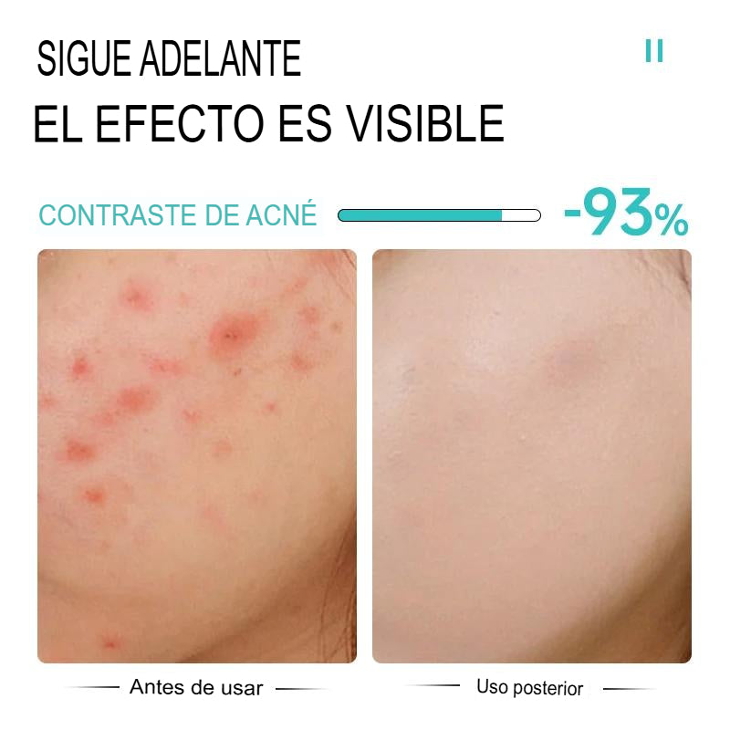 (2x1) Crema Anti Acné "Bioaqua" Lleva 2 Cremas