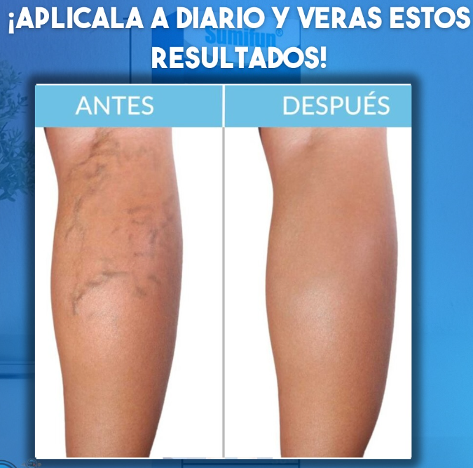Varicose Veins (Crema para varices)