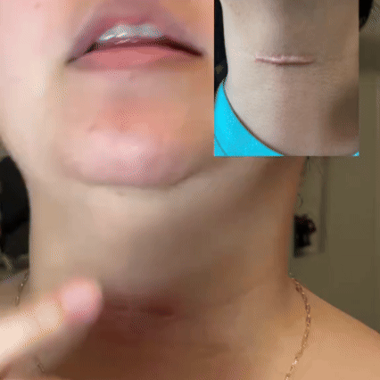 Gel Avanzado para Cicatrices