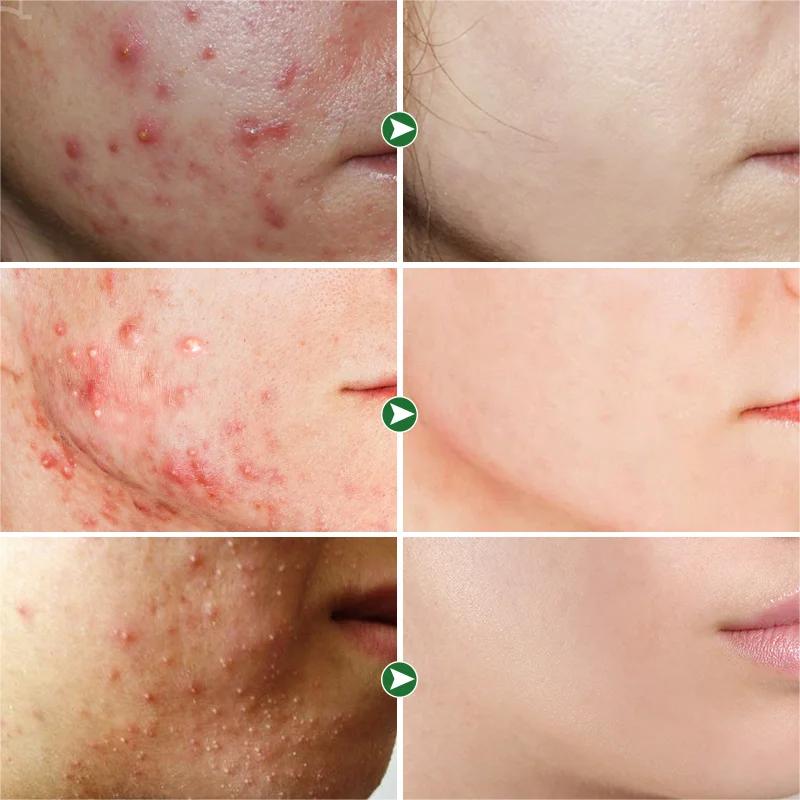 (2x1) Crema Anti Acné "Bioaqua" Lleva 2 Cremas