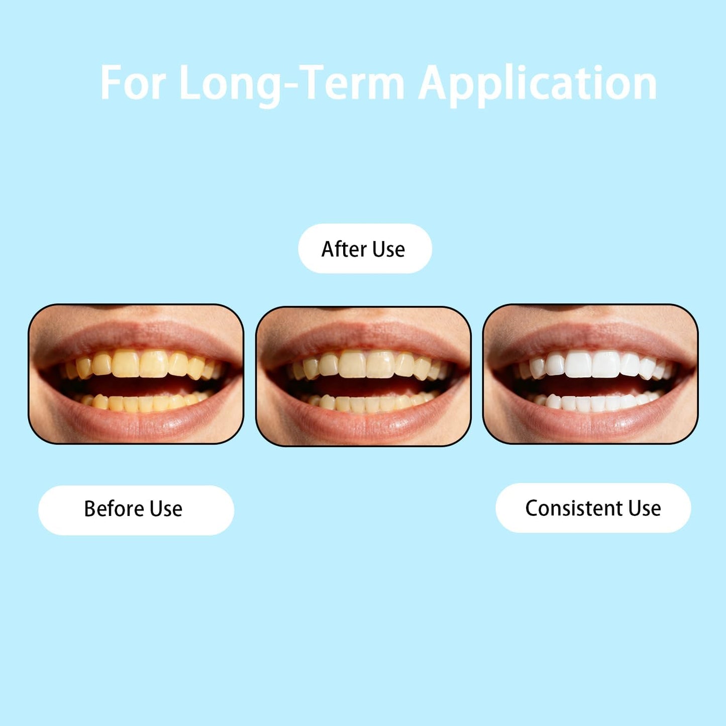 Armadura Esmalte Dental Radiante Instantánea