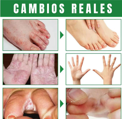 Spray AntiHongos
