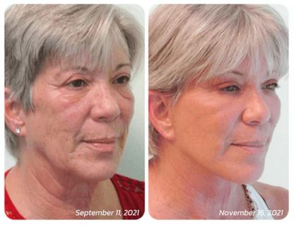 Parches de Mascarilla Soluble de Colágeno Hidrolizado (Incluye Spray de Colágeno)