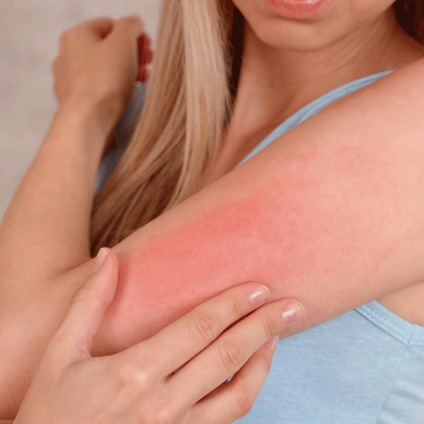 Crema Natural Alivio Psoriasis Intensiva