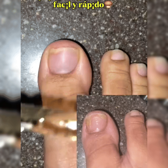 RenuevaUñas Extra Fuerte Solución Clínica